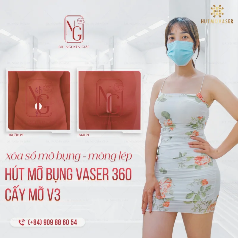 vong 2 vong 3 goi cam sau khi phau thuat