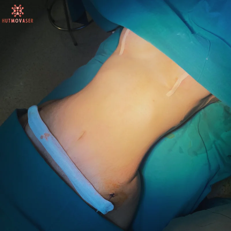 hut mo bung cong nghe vaser