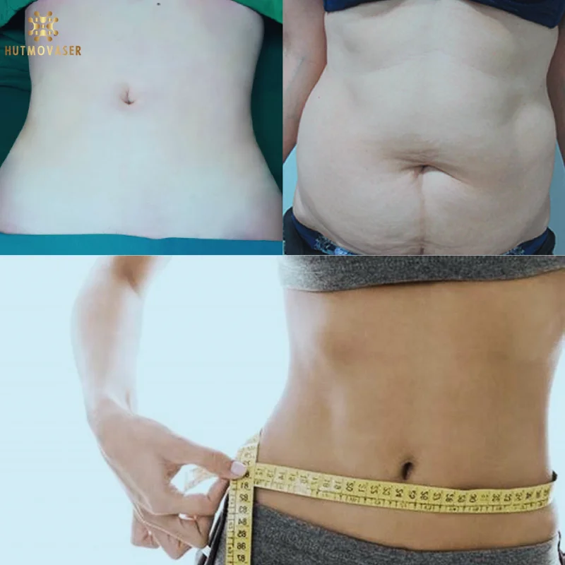 hut mo bung khong phau thuat giup giam mo