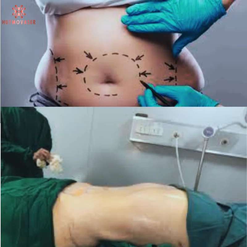 phuong phap liposonix su dung song sieu am